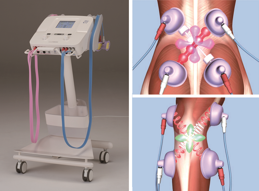 干渉派治療器(IFCアルファ1)大阪豊中市これなり整骨院